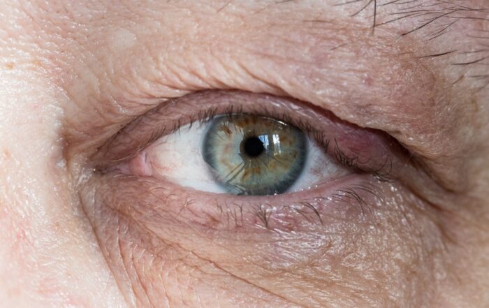 como es una prótesis ocular